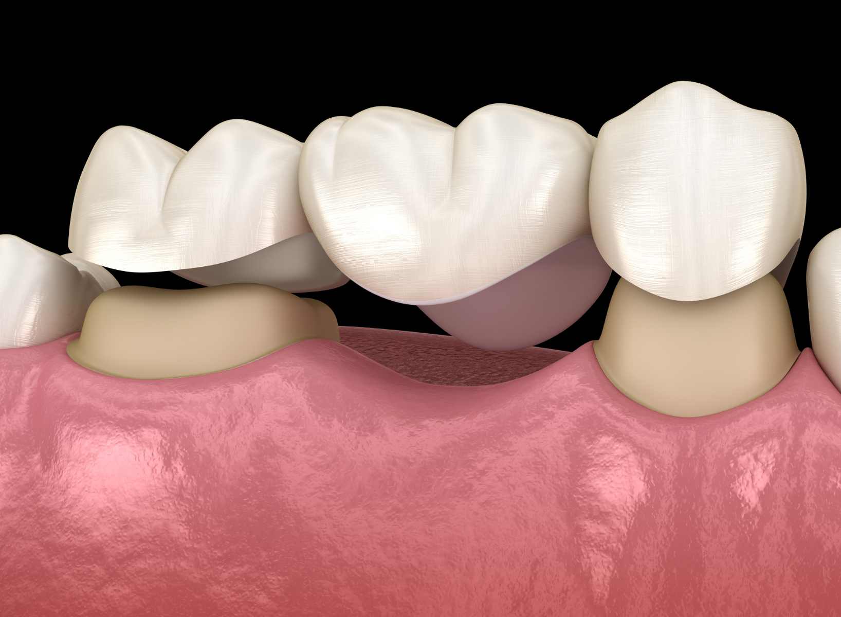 Dental Bridges and Crowns at Aegis Dental Studio in Chembur, Mumbai, India