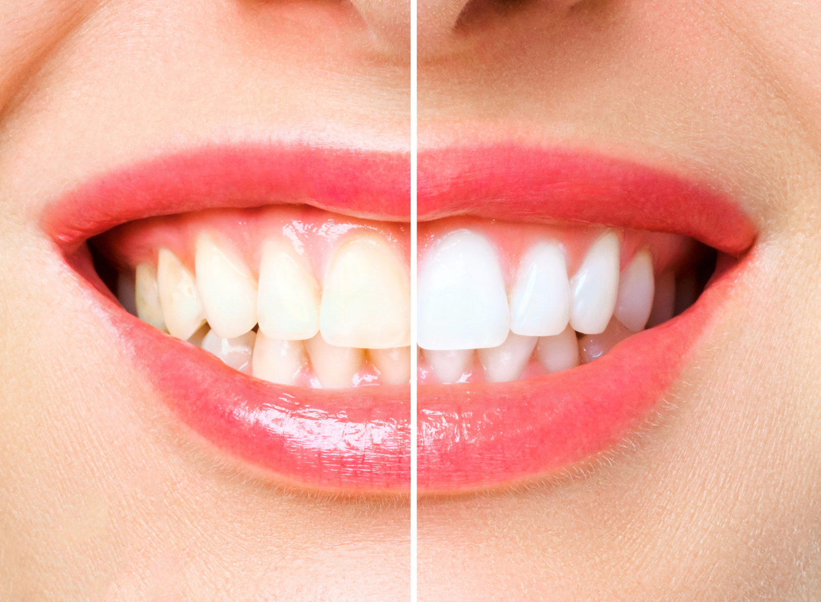 Teeth Whitening at Aegis Dental Studio in Chembur, Mumbai, India