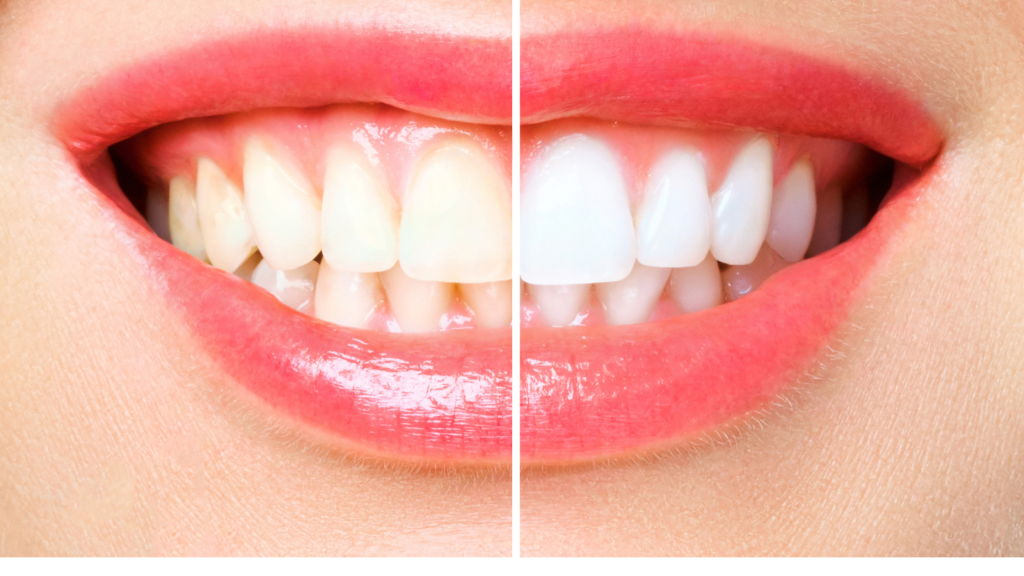 Teeth Whitening at Aegis Dental Studio in Chembur, Mumbai, India