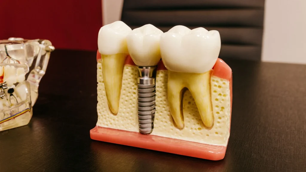 Dental Implants at Aegis Dental Studio, Chembur East