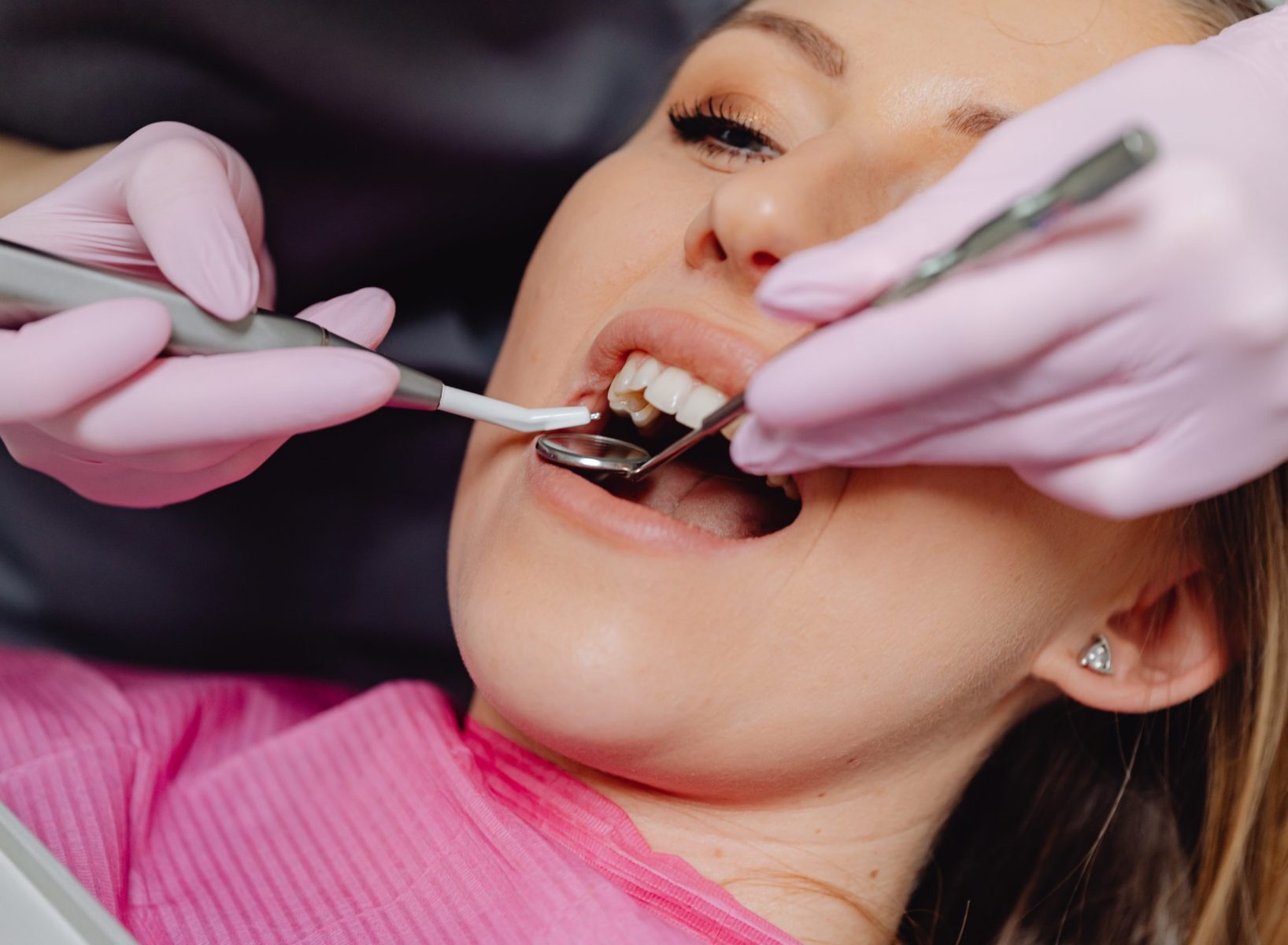 Dental Fillings